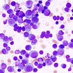 Anne Lower - @hi.myeloma - Instagram