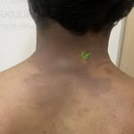 Dr Ashima Goel MD Dermatologist - @lichenplanuspigmentosus_lp_lpp - Instagram