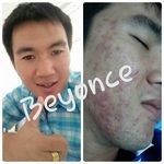 สิว ฝ้า กระ จุดด่างดำ By Bella - @beyonce_bella02 - Instagram