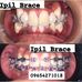Ipil Brace - Facebook