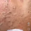 Big Pimple - @elitenailsspa - TikTok