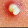 pop_my_pimple - @pop_my_pimple - TikTok