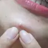 Humphries - @humphries.acne - TikTok