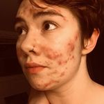 Hannah Galloway - @hanners.skin.journey - Instagram