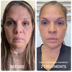 Total Body Contouring TFS | Iris Reese Cary, North Carolina - @totalbodycontouringtfs - Instagram