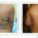 Lipoescultura Tecnica Europea - @johnarmandolios - Instagram