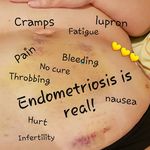 Laura_Endo_warrior - @laura_endo_warrior - Instagram