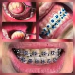 Liiyyah Brace - Facebook