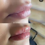 Needless lip filler✨ - @lunalipss_ - Instagram