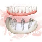 Michael Zani - @aria.dental.samedayteeth - Instagram