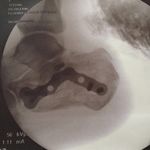 Michelle Moreau - @shatteredcalcaneus - Instagram